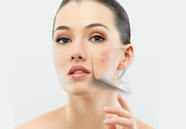 Antes de realizarse un tratamiento láser, debes suspender tu tratamiento contra el acné.