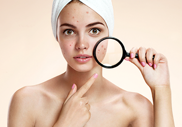 El acné y la depilación láser no son compatibles.